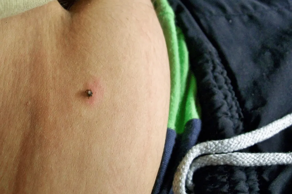 come riconoscere puntura di zecca