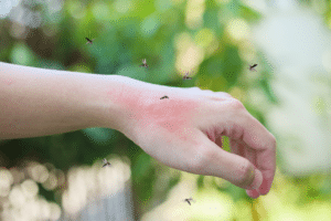 Primo piano di un mano leggermente arrossata attaccata da uno sciame di zanzare