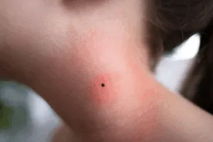acaro trombicula Milano