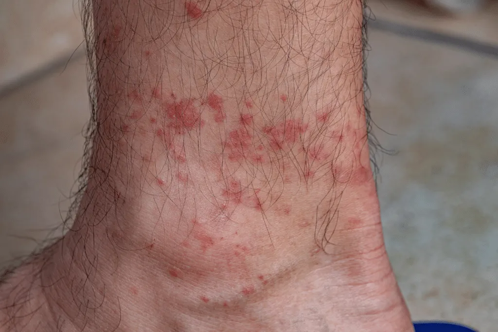 zecche sul corpo umano